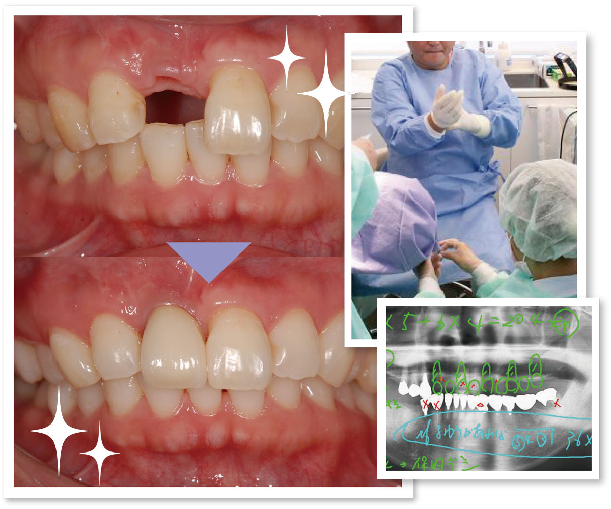 自分の歯を守るインプラント